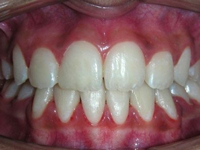 dental-treatment-in-calicut